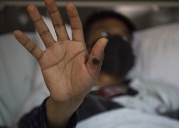 Siete casos de viruela del mono en Quintana Roo