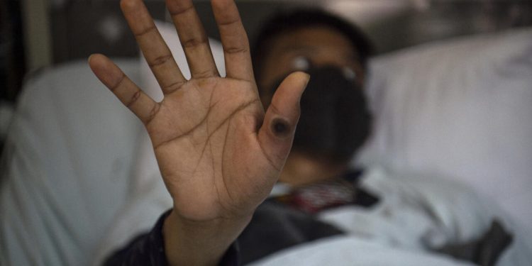 Siete casos de viruela del mono en Quintana Roo