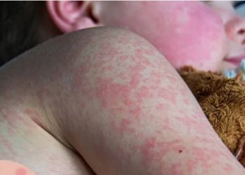 Confirmados más de 3 mil casos de sarampión en México