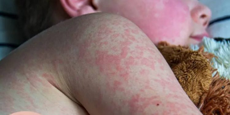 Confirmados más de 3 mil casos de sarampión en México