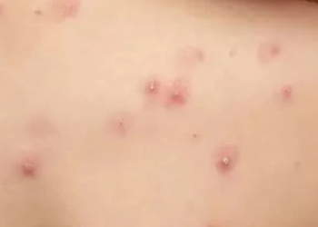 Primera muerte por viruela símica confirmada en Quintana Roo: joven de 24 años fallece en Cancún