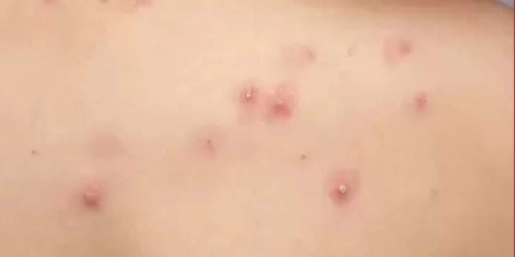 Primera muerte por viruela símica confirmada en Quintana Roo: joven de 24 años fallece en Cancún