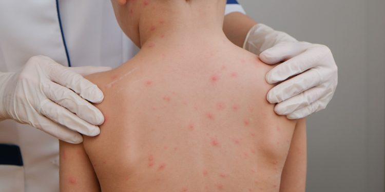 México confirma primer deceso por sarampión en 2026; suman casi mil contagios a nivel nacional