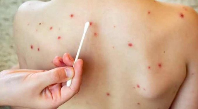 Dos casos de sarampión son atendidos en Playa del Carmen en medio del brote nacional