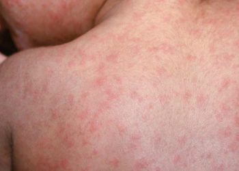 México registra tres nuevas muertes por brote de sarampión; casos superan los 9 mil 800