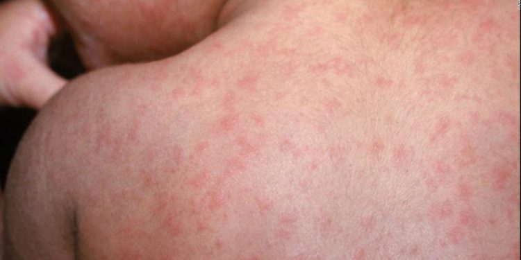 México registra tres nuevas muertes por brote de sarampión; casos superan los 9 mil 800