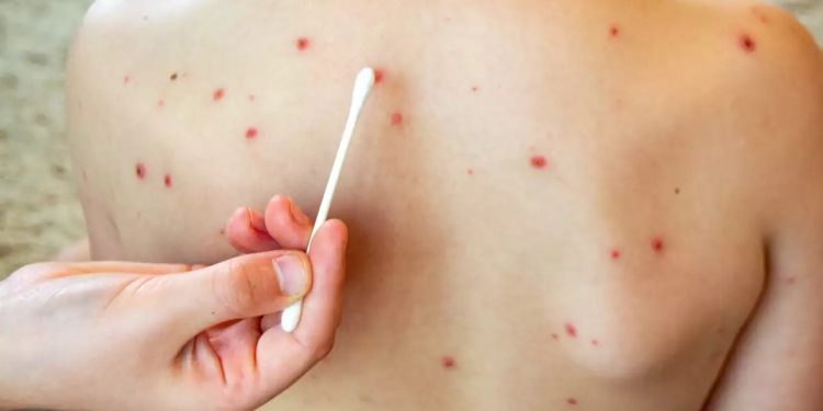 Tabasco descarta filtros sanitarios en escuelas ante casos de sarampión